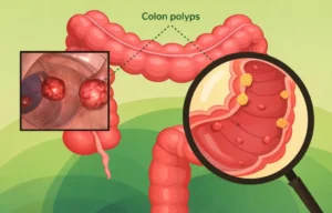 bowel-poylps-colon-close-up__FitMaxWzEyMDAsNjc1XQ_ExtRewriteWyJqcGciLCJ3ZWJwIl0